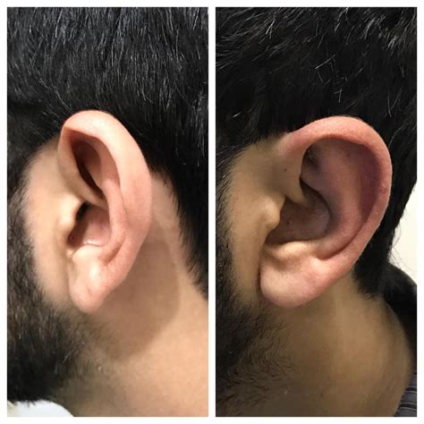 Otoplasty Or Ear Reshaping Surgery In Pakistan Lahore Cost