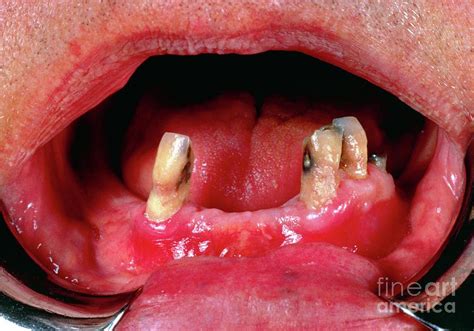 Mouth Of Person With Scurvy Photograph By Biophoto Associatesscience