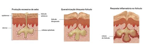 O que causa e como se trata a Acne PT Medical Saúde ao Domicílio