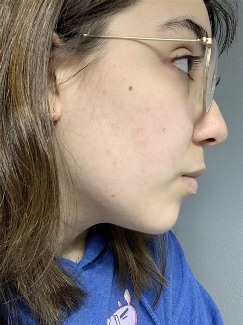 Skin Concern Ive Had These Red Bumps On My Face For About A Year