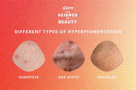 What Is Hyperpigmentation The Science Of Beauty Podcast Allure