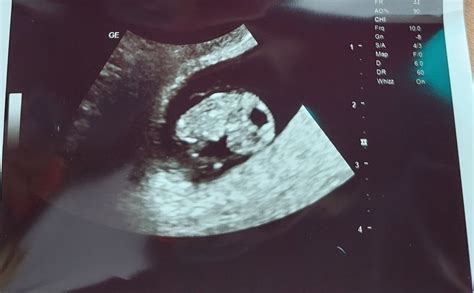 9 Week Ultrasound Babycenter