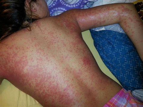 Allergic Reaction To Penicillin A Very Inflamed Itchy Rash That Covered Her Body From Head To