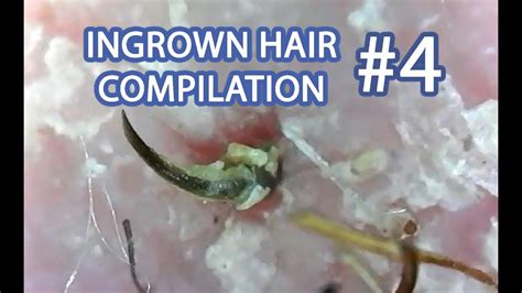 Ingrown Hair Compilation 4 Some Of My Best Pops And Plucks Youtube