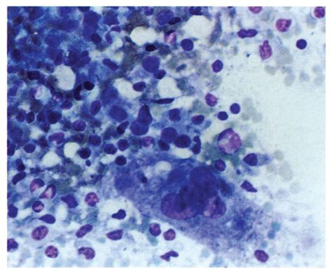 Fine Needle Aspiration Cytology Of Hepatic Angiomyolipoma Case Report