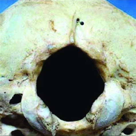 Skull With Occipital Emissary Foramen On Left Side N5 64 A Pin