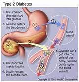 Images of Non Insulin Diabetes Treatment