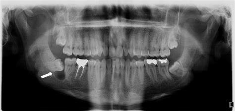 Jaw Lesions Associated With Impacted Tooth A Radiographic Diagnostic