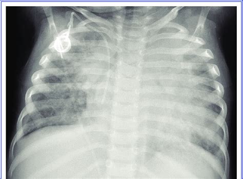 Anteroposterior Chest X Ray Of The Patient Revealing Bilateral
