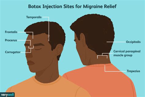 Uso De Botox Para La Prevención De La Migraña Medicina Básica