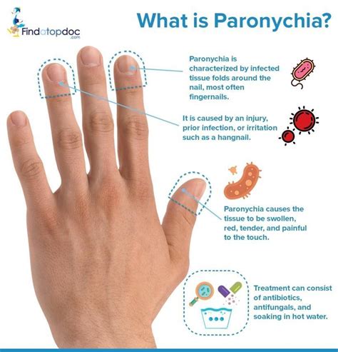 What Is Paronychia Infographic