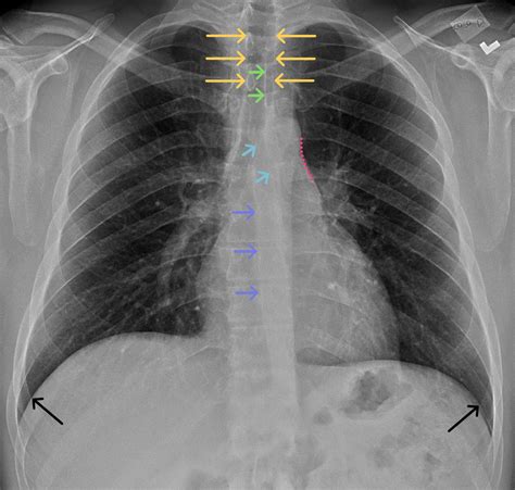 Radiographic Anatomy Of Chest X Ray Drop The Daily Chest X Rays For My Xxx Hot Girl