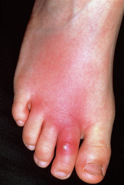 Cellulitis On Top Of Foot