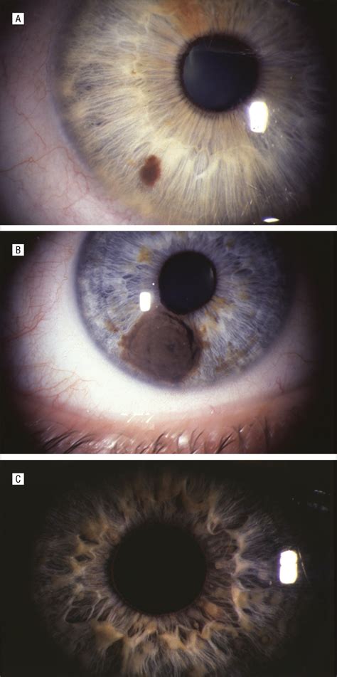 Pigmented Lesions Of The Iris Common In Patients Uncommon In