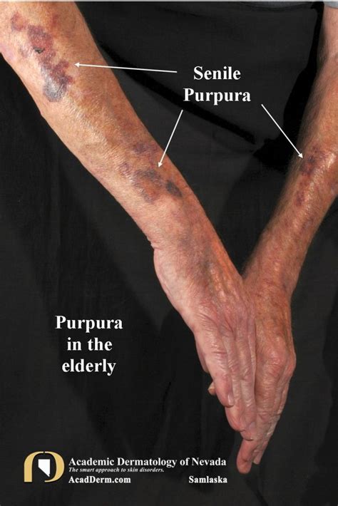 Senile Purpura Bruising In The Elderly Academic Dermatology Of Nevada