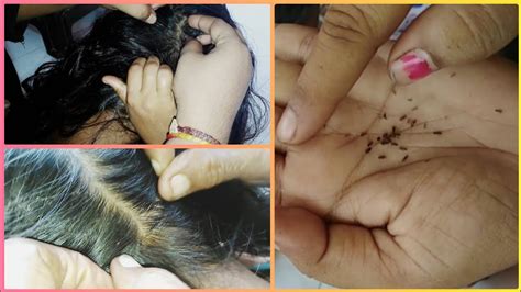 Head Lice Picking Nit Picking Nit Lifting And Picking In