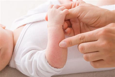 Dermatite Atopica Nei Bambini Cause Sintomi Trattamento