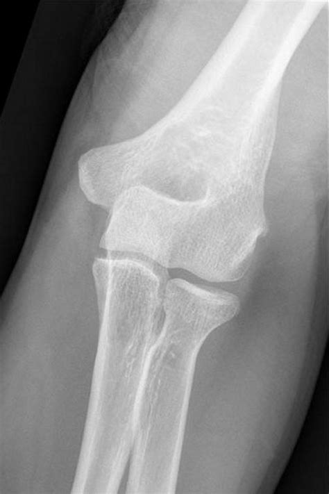 Radial Head Fractures Trauma Orthobullets