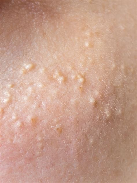 Whats That On Your Face Skin Bumps White Bumps On Face Skin Tag Images And Photos Finder