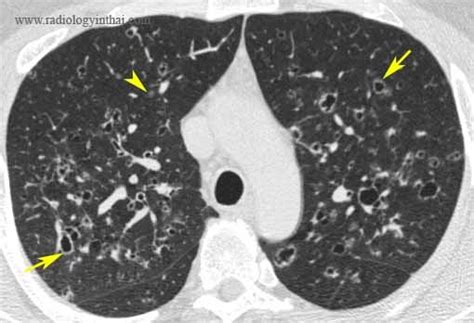 Rit Radiology Pulmonary Langerhans Cell Histiocytosis