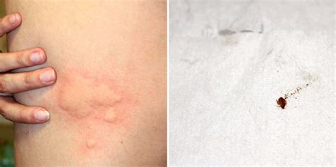 Bed Bugs In Your Skin
