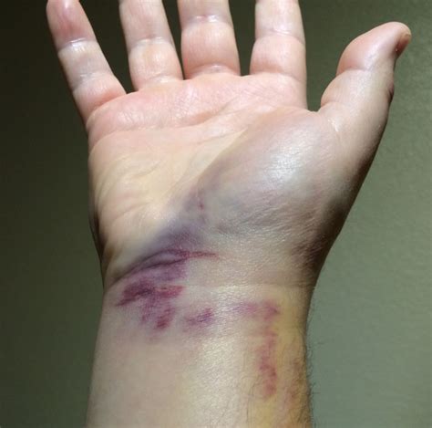Wrist Bruised Webb Pickersgill