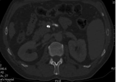 Duodenal Variceal Bleed An Unusual Cause Of Upper Gastrointestinal