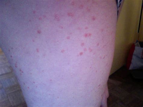 I Have A Rash That Began On My Upper Thighs And Has Spread