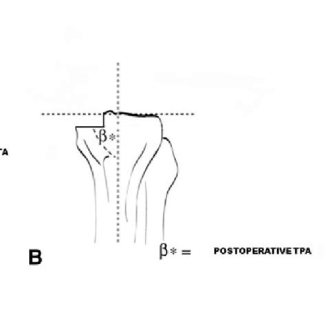 A C Postoperative Radiographic Measurements Of A Femorotibial Angle
