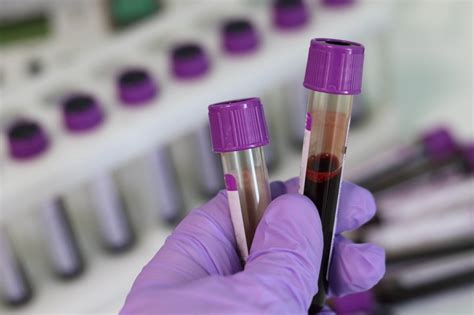 Groundbreaking Multi Cancer Screening Blood Test Can Diagnose 50 Types