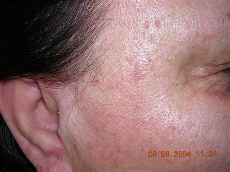 Sebaceous The Outcome Is All That Counts Laser Health Body Slim