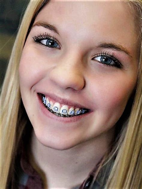 Images By John Beeson On Girls In Braces B