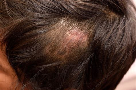 Ringworm Fungal Infection Of The Scalp Stock Image C0372259