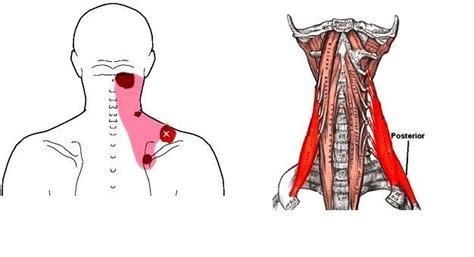 what you need to know about muscle knots or trigger points trigger points muscle knots