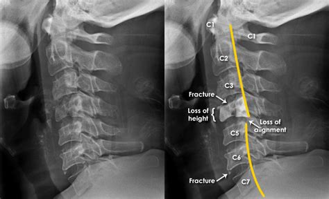 Trauma X Ray Axial Skeleton Gallery 1 Cervical Spine Fractures