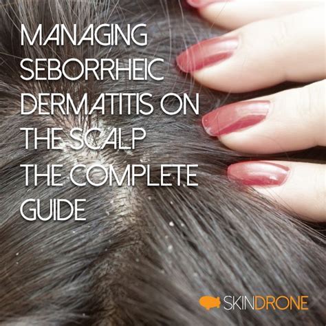 seborrheic dermatitis on the scalp the complete guide skindrone