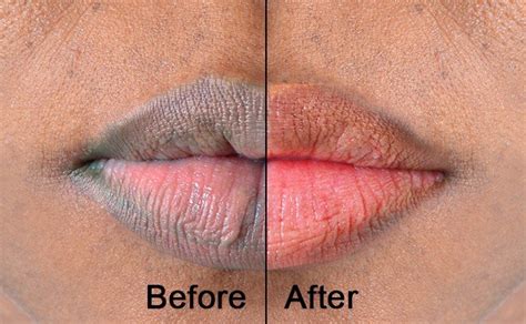 6 Remedies To Lighten Lip Pigmentation