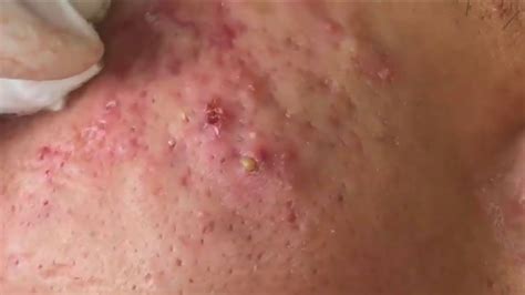 8 Acne Treatment Youtube