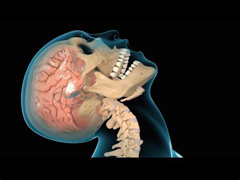 Concussion Traumatic Brain Injury Tbi 14032012 Nucleus Medical