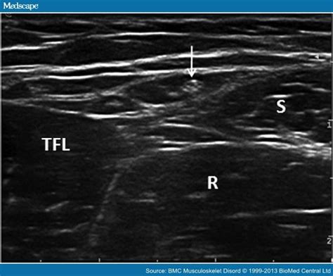 Ultrasound Of The Lateral Femoral Cutaneous Nerve In Adults