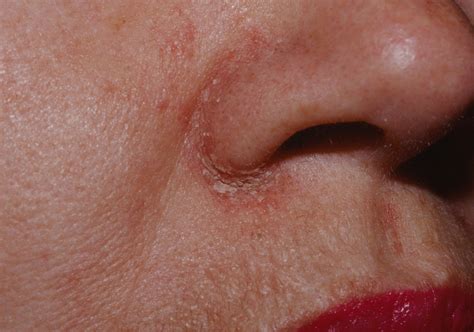 Seborrheic Dermatitis On Nose Pictures Photos The Best Porn Website