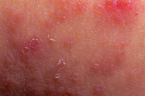 Eczema Causes Symptoms And Treatments Free Eczema
