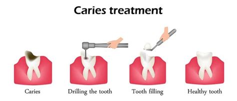 Dental Fillings Procedure Details Recovery Time And Cost Info