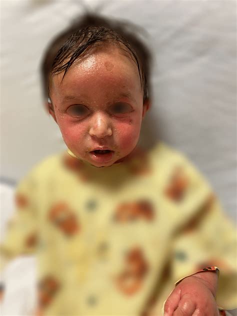 Cureus Staphylococcal Scalded Skin Syndrome In A Ten Month Old Male