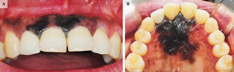 Intraoral Malignant Melanoma Nejm