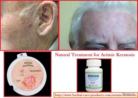 Herbal Treatment For Actinic Keratosis Healthbeautyfitness Pasig