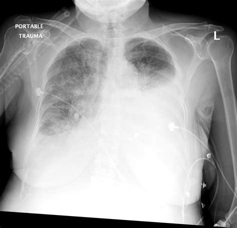 Pulmonary Edema Vs Pleural Effusion