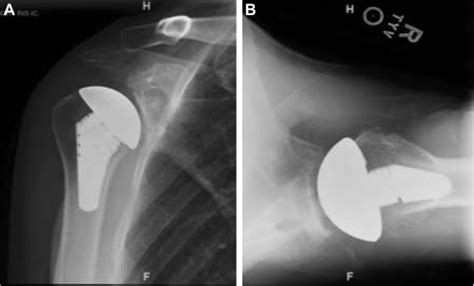 Amyloid Deposition In The Glenohumeral Joint A Case Report Jses
