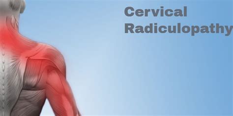 Cervical Radiculopathy Symptoms Treatments Legacy Spine Neurological Specialists