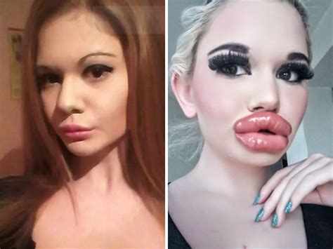 Largest Lips In The World